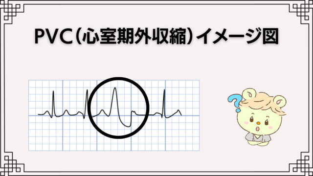 PVC（心室期外収縮）イメージ図