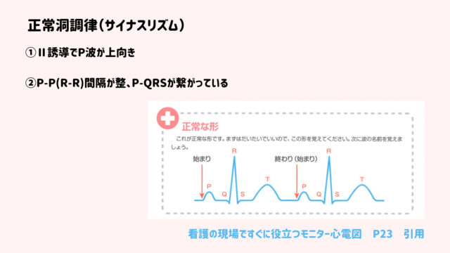 【正常洞調律】の定義と画像