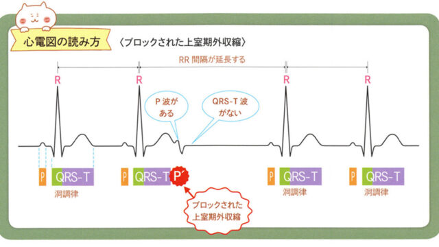 心電図の読み方　ブロックされた上室期外収縮