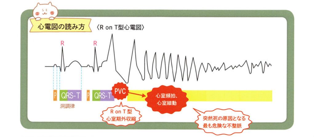 心電図の読み方　R on T型心電図